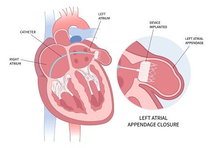 Atrial Fibrillation (AFib) Treatment