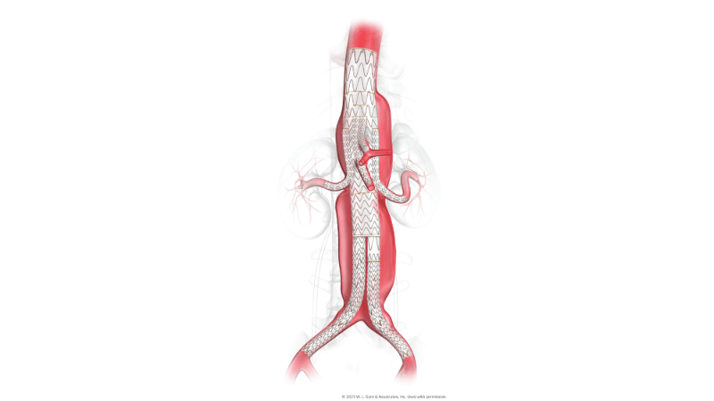 A graphic recreation of the TAMBE device shows it inside the aorta. 