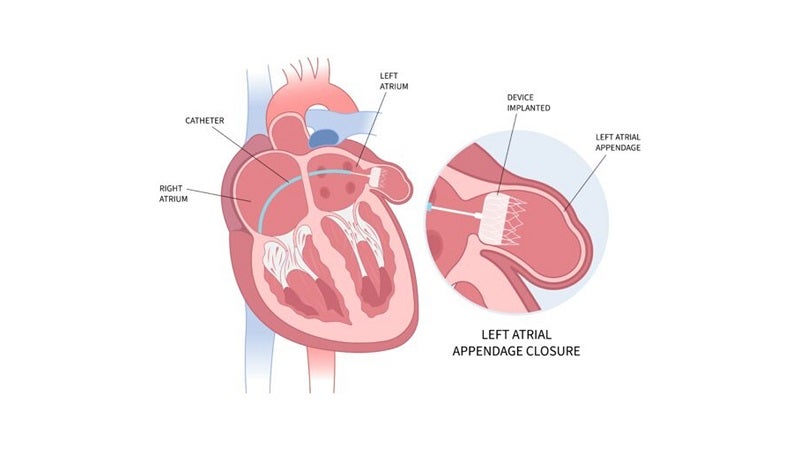 Watchman procedure
